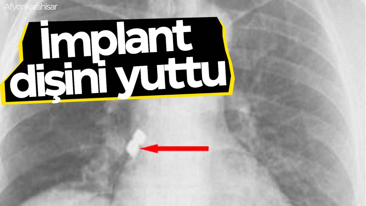 Diş doktorunda implantı yuttu… Az kalsın canından oluyordu!