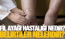 Fil ayağı hastalığı nedir, belirtiler nelerdir? Fil ayağı hastalığı neden olur?