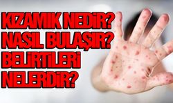 Kızamık nedir? Nasıl bulaşır? Belirtileri nelerdir?