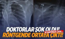 Aydın’da genç kız 18 santimlik çatal yuttu!