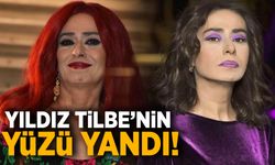 Yıldız Tilbe’nin yüzü yandı