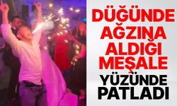 Düğünde ağzına aldığı meşale yüzünde patladı