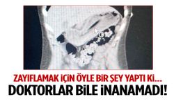Zayıflamak için öyle bir şey yaptı ki… Doktorlar bile inanamadı!