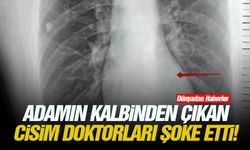 Adamın kalbinden çıkan cisim doktorları şoke etti!
