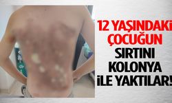 12 yaşındaki çocuğun sırtını kolonya ile yaktılar!