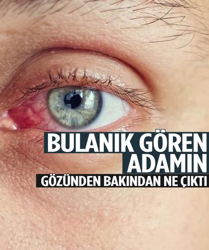 Bulanık gören adamın gözünden bakın ne çıktı! Doktorlar bile inanamadı…