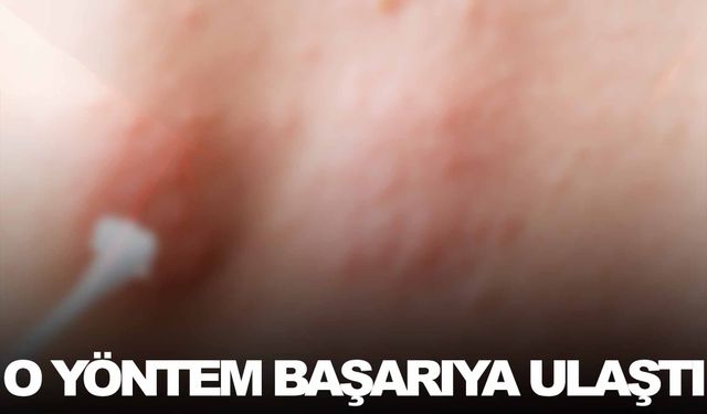 Zona hastalığında o yöntem başarıya ulaştı