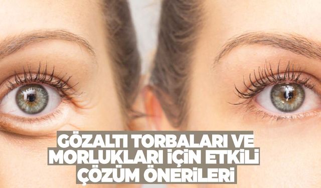 Gözaltı torbaları ve morlukları nasıl geçer? Etkili çözümleri uzmanları açıkladı