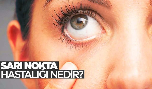 Sarı nokta hastalığı nedir? Belirtileri nelerdir?