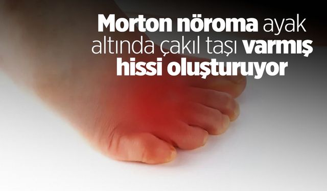 Morton nöroma ayak altında çakıl taşı varmış hissi oluşturuyor