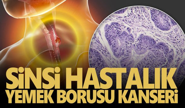 Uzmanından yemek borusu kanseri uyarısı