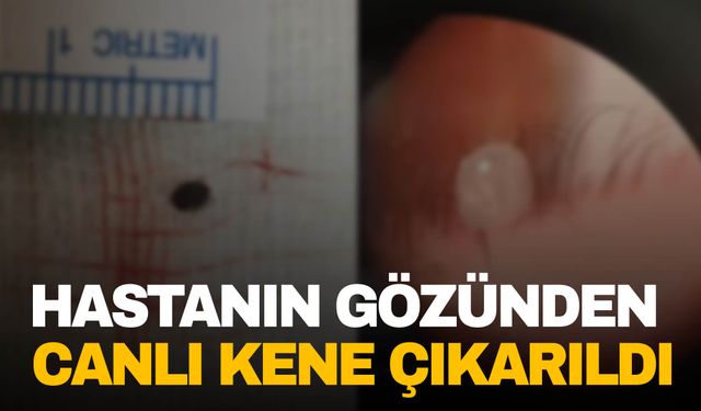 Göz ağrısı şikayetiyle hastaneye başvurmuştu… Gözünde canlı kene çıktı!