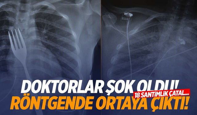 Aydın’da genç kız 18 santimlik çatal yuttu!