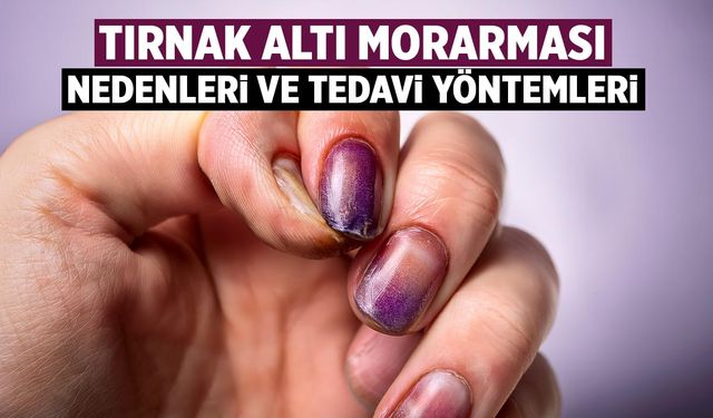 Tırnak Altı Kanaması Neden Olur? Subungual Hematom Tedavisi