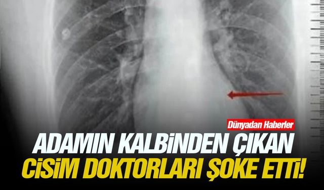 Adamın kalbinden çıkan cisim doktorları şoke etti!