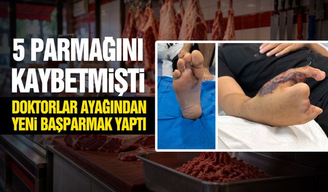 5 parmağını kaybetmişti! Doktorlar ayağından yeni başparmak yaptı